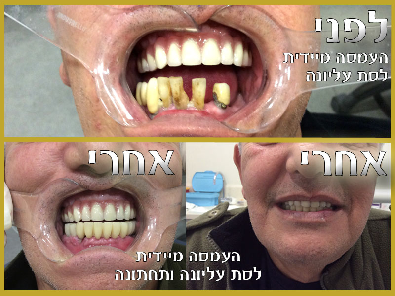 העמסה מיידית לפני ואחרי - תמונה להמחשה